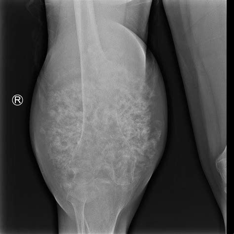 Chondrosarcoma Pulse Md