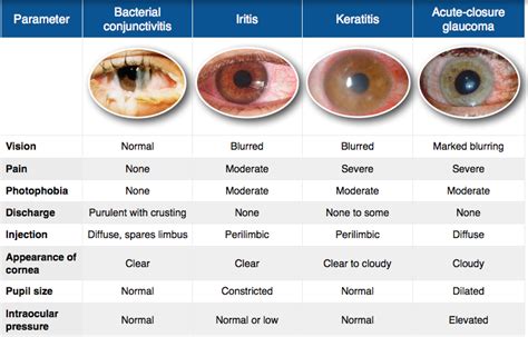 Red Eye Differential Diagnosis Eye Facts Opthalmic Technician Eye