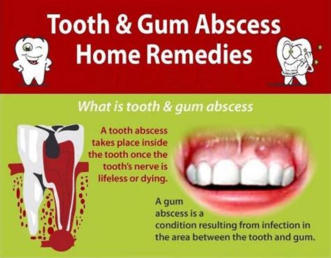 When left untreated, the abscess comes out via tissues of the. #dental #dentalcare | Dental, Dentist