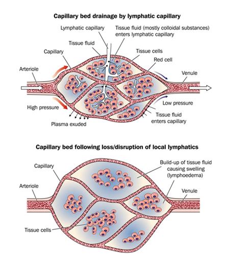 Lymphedema Introduction And Assessment