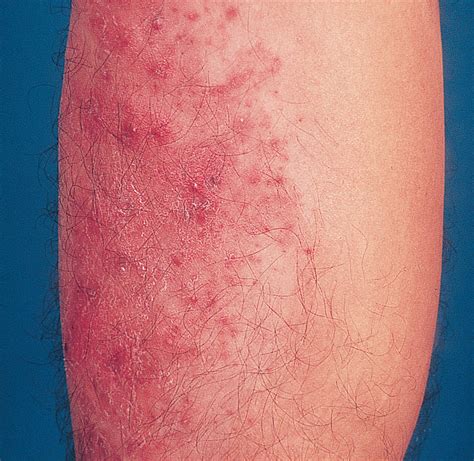 Unusual Papular Lesions In A Healthy Man Dermatology Jama