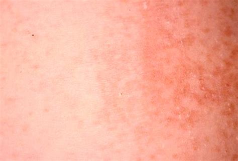 Maculopapular Rash Pictures Treatment Symptoms Causes
