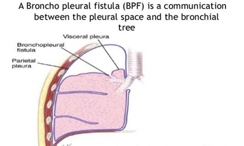 What Is A Fistula Causes Diagnosis Treatment All You Need To Know