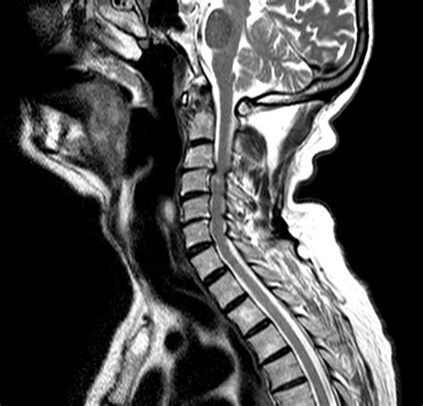 Compressed Spinal Cord Photograph By Du Cane Medical Imaging Ltd