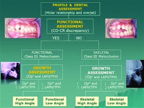 Classification Of Developing Class Iii Malocclusion For Early