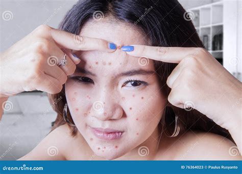 Teenage Girl Touching Acne Stock Image Image Of Dermatology