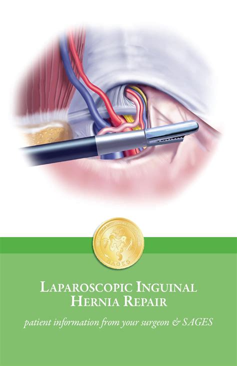 Laparoscopic Inguinal Hernia Repair Anatomy Anatomy S Vrogue Co