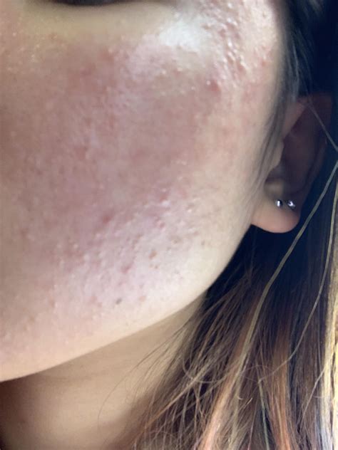 Small Bumps Everywhere On Face Acne