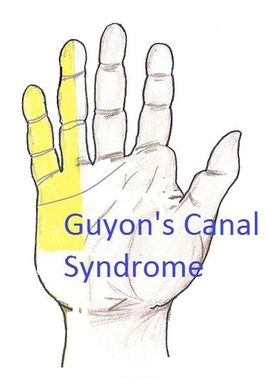 Guyons Canal Syndrome Ehealthstar