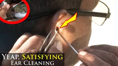 Best Ear Cracking Ever Dead Infected Skin Earwax And Dirt Removed Of
