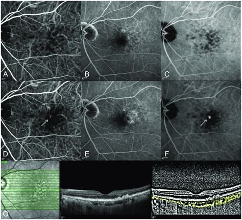 A 72 Year Old Woman With Right Eye Type 3 Neovascularization A C At