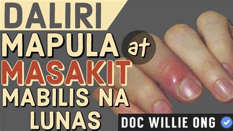Daliri Mapula At Masakit Mabilis Na Lunas By Doc Willie Ong 1047