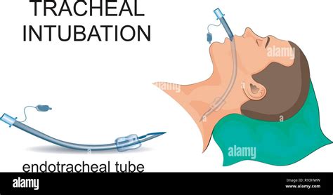 Vector Illustration Of Tracheal Intubation Artificial Ventilation Of