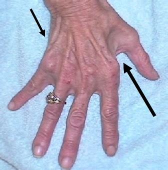 Cubital Tunnel Syndrome Claw Hand