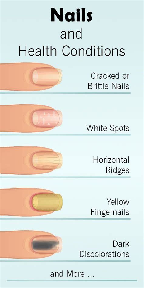 How Your Nails Warn You About Serious Health Conditions Fingernail