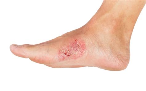 Skin Ulcers Causes Diagnosis And Effective Treatments