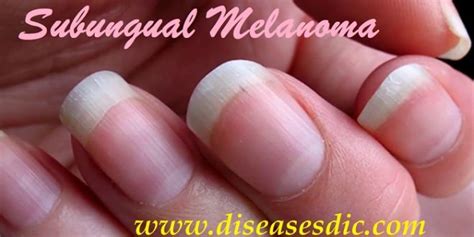 Subungual Melanoma Description Treatment And Prevention