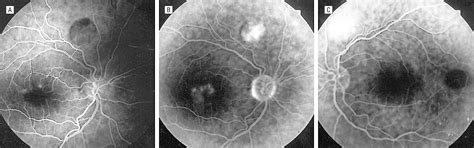 Normal Electro Oculogram In A Patient With Vitelliruptive Macular
