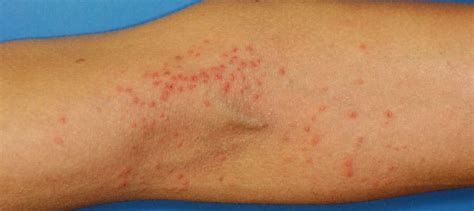 Skin Rash Causes And Treatment Vrogue Co