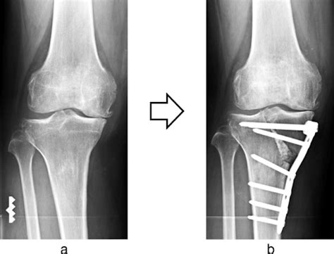 Osteotomy Of The Knee Sudhahar Ortho