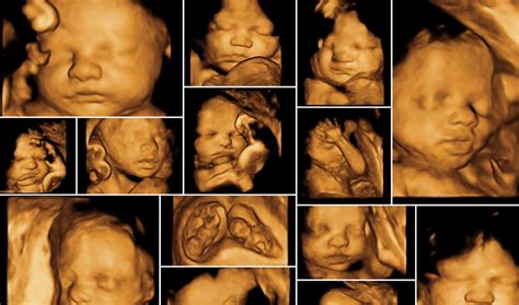 3d Ultrasound How Much Does It Cost And When Is It Done