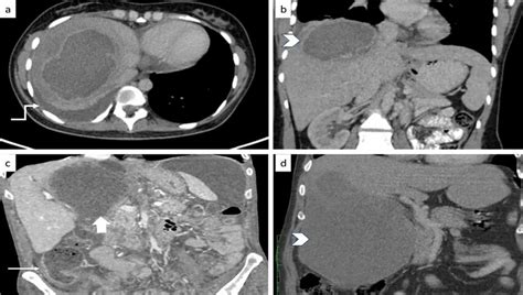 Amoebic Liver Abscess In Four Different Patients Managed With Pcd A