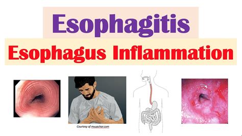 Esophagitis Esophagus Inflammation Causes Risk Factors Signs And