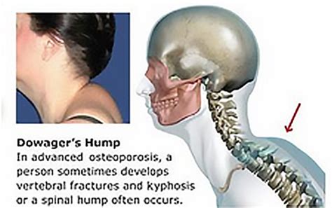 Healthy Neck Posture Muscles Connected To Skull