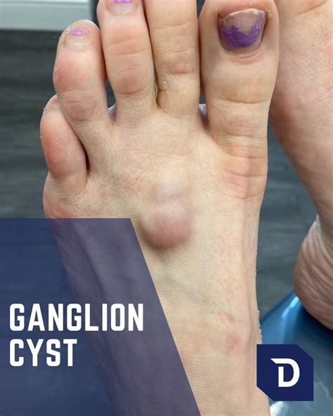 Ganglion Cysts Foot And Ankle Specialist Bible Cyst Treatment