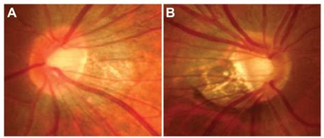 Optic Disc Photographs Fulfilling Our Criteria Of The T Open I