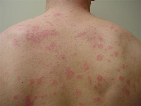 5 Things To Know About Pityriasis Rosea Pityriasis Ro Vrogue Co