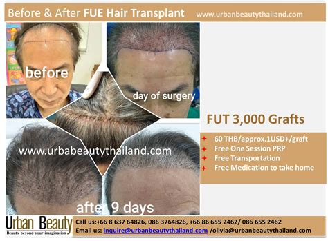 Fue Hair Loss Solutions Thailand Grow Back Your Hair In Thailand Hair
