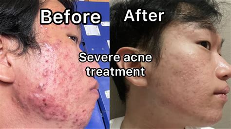 Very Severe Cystic Acne Treatment Transformation After 5 Month Of