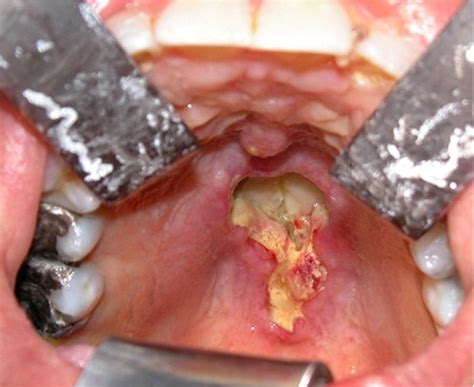 Presentamos el caso de una mujer de 34 años de edad con infección por vih que. Management and outcomes of three cases of rhinocerebral ...