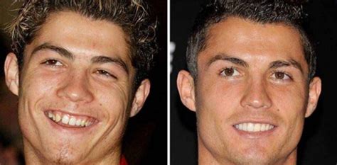 Cristiano Ronaldo Plastic Surgery Before And After Pictures