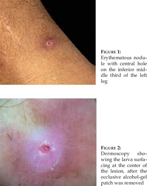 Figure 1 From Dermoscopy As An Auxiliary Tool For The Diagnosis Of Furuncular Myiasis