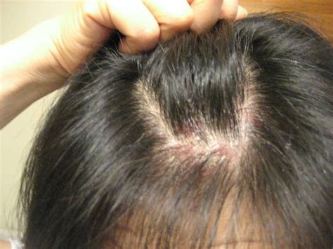 Understanding The Symptoms Of Skin And Scalp Psoriasis Curly Chic