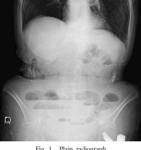 Figure 1 From A Case Of Intestinal Obstruction Secondary To A