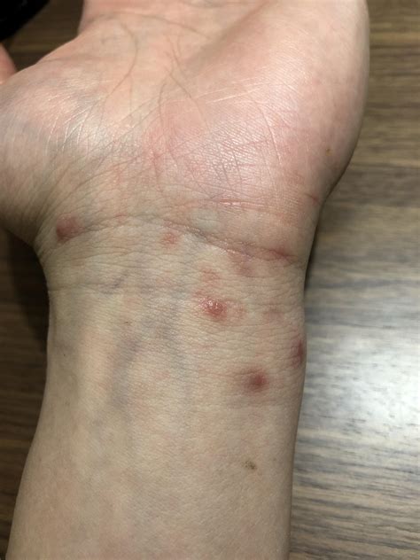2 Days After Taking Moxidectin Scabies