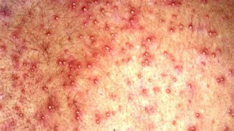 Having white bumps on legs can be worrisome. Heat rash: Symptoms, appearance, and causes
