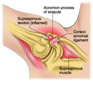 It's especially common among people who do a lot of overhead movements, including weightlifting (think shoulder presses) and even yoga (downward dog). What is Shoulder Impingement and How to Treat it | The ...