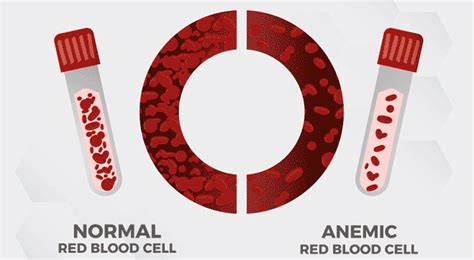 Sickle Cell Anemia Types Symptoms Causes Treatments