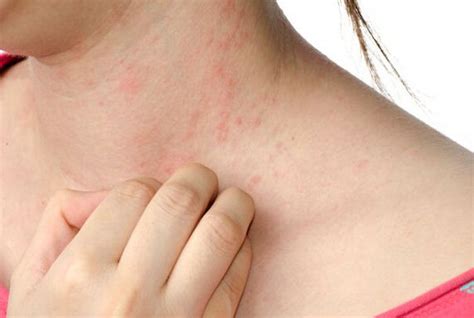 How To Get Rid Of Hives Fast On Face Howto Wiki