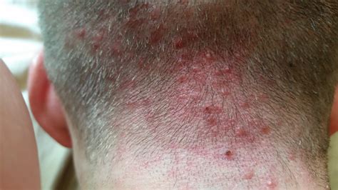 Scalp Bumps Large Bumps On Scalp Red Bumps On My Scalp Itchy Bumps Porn Sex Picture