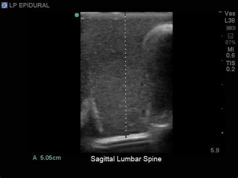 Blue Phantom Spinal Epidural Lumbar Puncture And Cervical Epidural