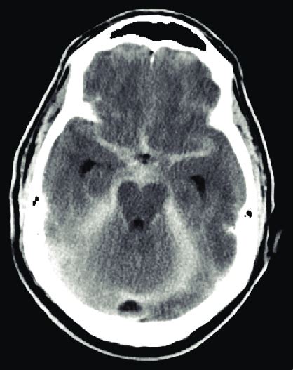 Noncontrast Axial Computed Tomography Of The Head Showing Diffuse