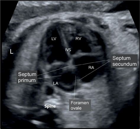 Fetal Echo Simplified 4 Chamber View Sujyotheartclinic
