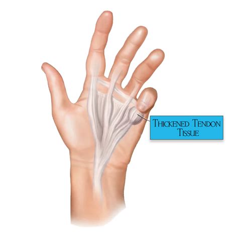 Dupuytrens Disease Dupuytrens Contracture Treatment Options