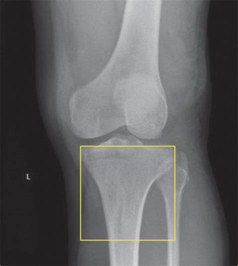 40 Tibial Plateau Fractures Musculoskeletal Key