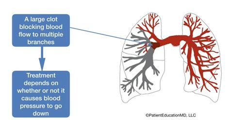 Treatments For Blood Clots In The Lungs Patienteducationmd